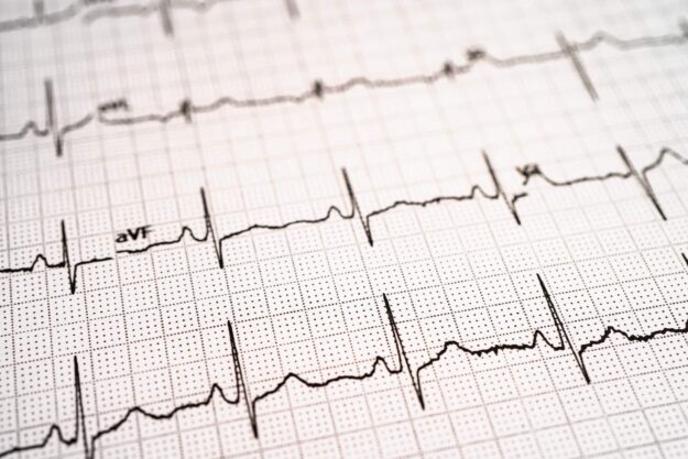 Electrocardiogram ECG, heart wave, heart attack, cardiogram report.